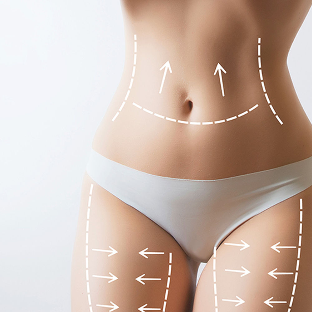 Liposuction Nedir ve Nasıl Yapılır?