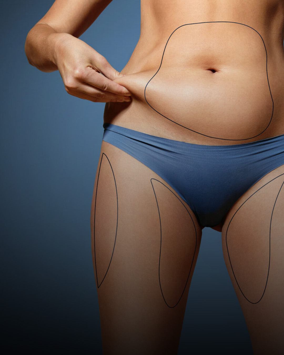 Liposuction