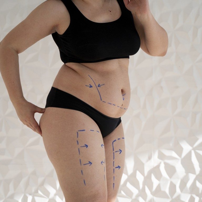 woman-s-body-with-marker-traces-side-view